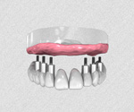 Les bridges sur implant dentaire